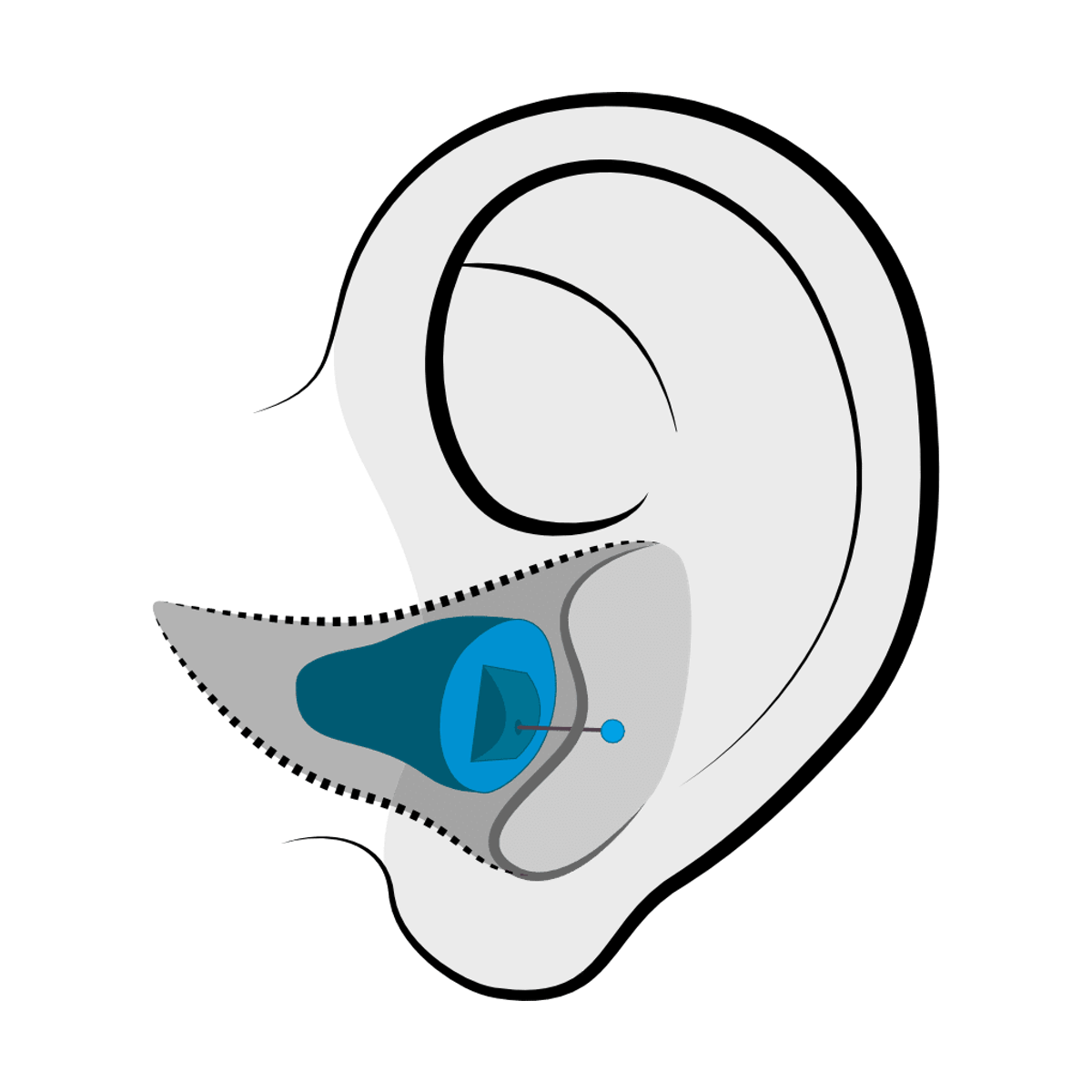 Invisible-in-Canal (IIC) hearing aid style available at Better Hearing Clinic in McAllen, TX